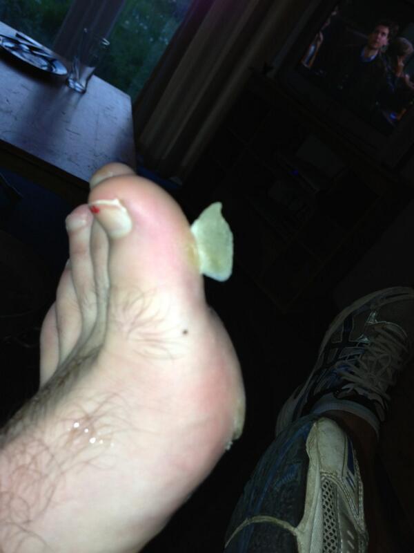 JJb162's tweet image. Bloody Rugby #hardground #summer #ouch