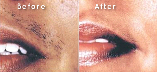 Before &amp; After IPL Permanent Hair Removal