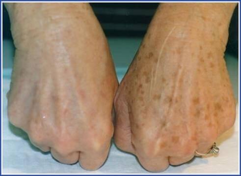 Before &amp; After IPL Pigment Removal. 
Visit mirellesbeauty.co.uk/Lynton-IPL1.ht… for more information.
