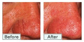 Before &amp; After IPL Red Vein Removal.
Please visit mirellesbeauty.co.uk/Lynton-IPL1.ht… for more information.