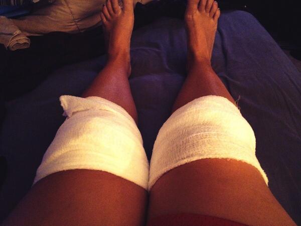 jesshornyak's tweet image. @ACL_life And I thought rehabbing one leg was tough...this is going to suck. Alot. #9thsurgery #twoatonce