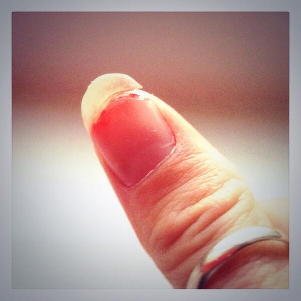 Won't be playing guitar for a few days #ouch