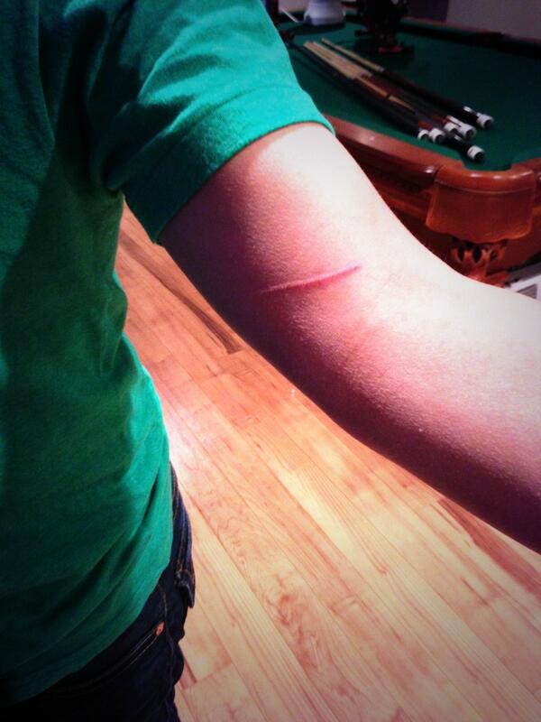 BStauch91's tweet image. Taking @rkgaudet to the hospital after some larsony, never be too careful playing mini sticks  #seegood