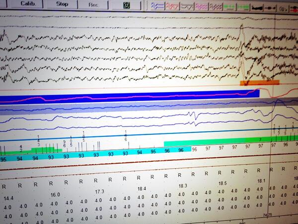 AustinCPAP's tweet image. Daytime sleep study in progress. Ever wondered what an apnea looked like through our eyes? #healthysleep