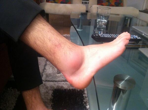 joemaleh's tweet image. My ankle is fucking killing me. #sprained #swollen #ankle