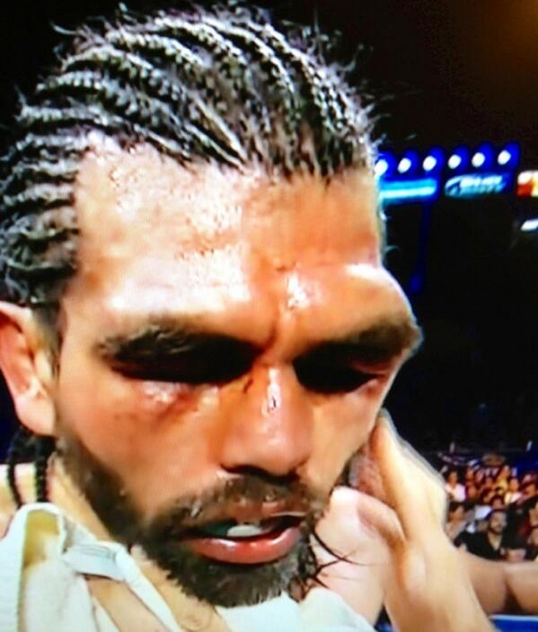 mariolopezviva's tweet photo. Saw this face up close sitting ringside yesterday. Not a good look... Hope he's doing better today 

#Boxing http://t.co/zOvYOaTO8w