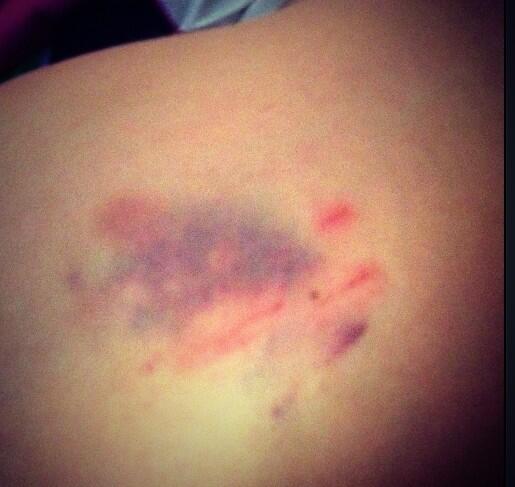 i_tweetsunshine's tweet image. Now that's a bruise #poolfail #😩