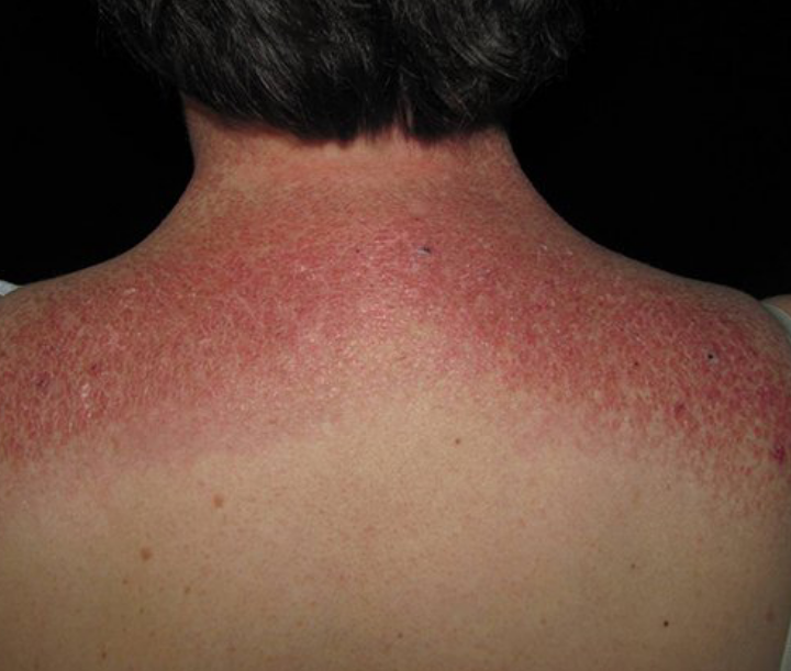 Internal medicine on Twitter: "Shawl sign in dermatomyositis ...