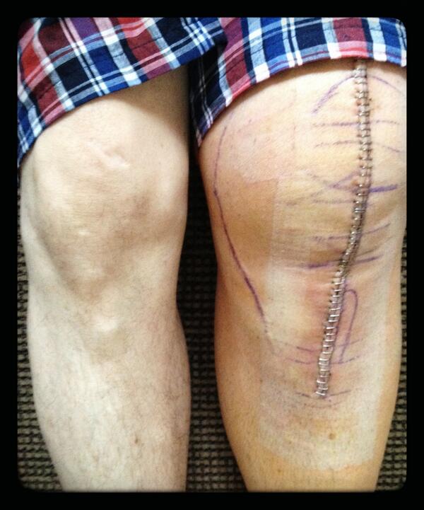 photo444's tweet photo. One week anniversary of the new knee almost to the minute. http://t.co/vlopS5P3O8