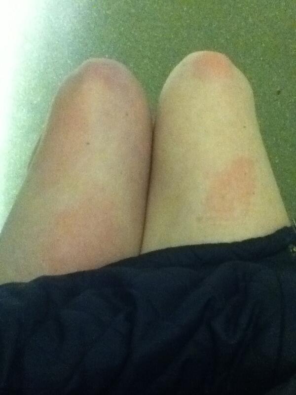 Engineer_Scotty's tweet image. The light was mean. Either that or I really had those fucking marks.

It's not bruises. My work never hurts me.