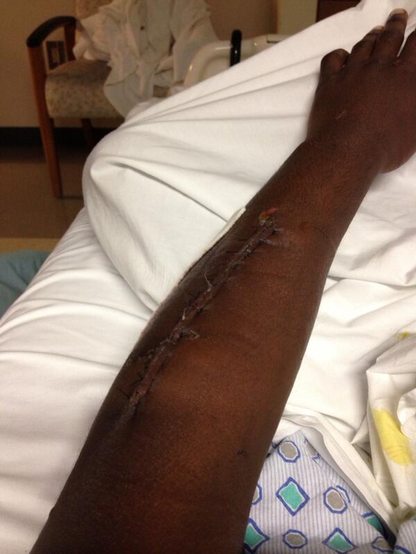 IamTeal's tweet image. My arm. #RealLifeStuff