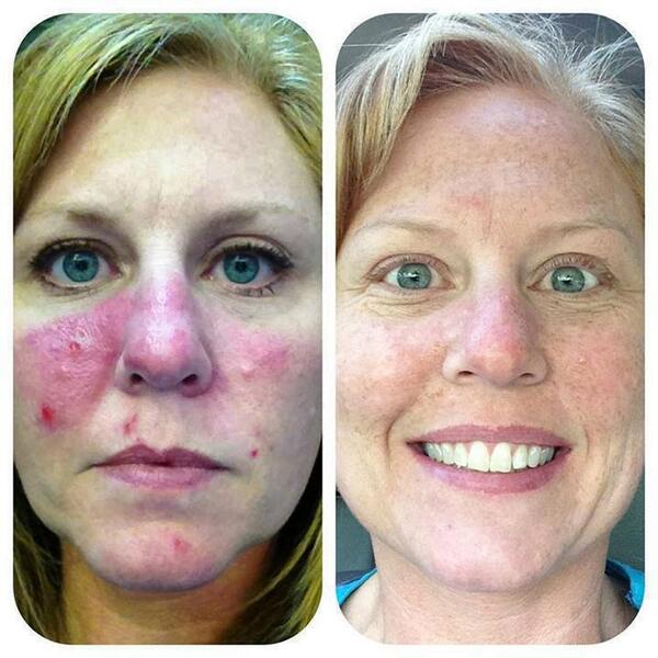 AMAZING! Before and After Results #RodanandFields These products can be found Here! kwerder.myrandf.biz/Shop/Reverse