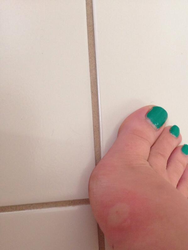 laurahhind's tweet image. Ffs hate how much I swell up to bites #alergic