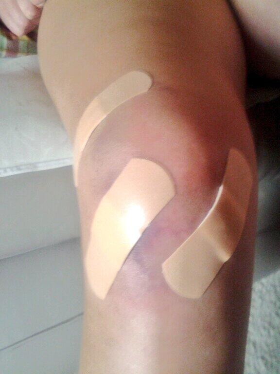 ingeuine's tweet image. This is what my knee looked like the day after surgery
