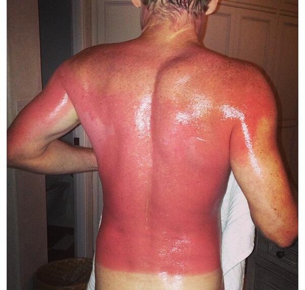 Bilderesultat for worst sunburn