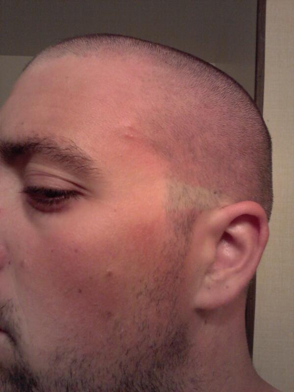 Goldenfritz's tweet photo. Scorched my fucken head http://t.co/E5nLVjLqnZ