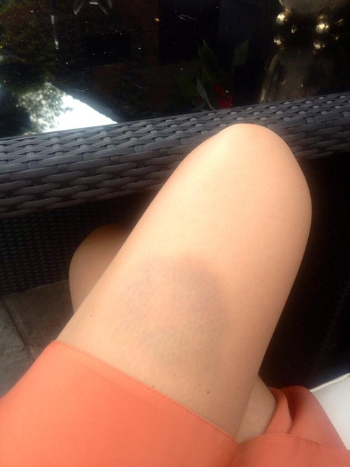 Nice bruise meh.... http://t.co/pPXZ1MjiLr<a href="/tag/wow"class="tags"><span>#wow</span></a>