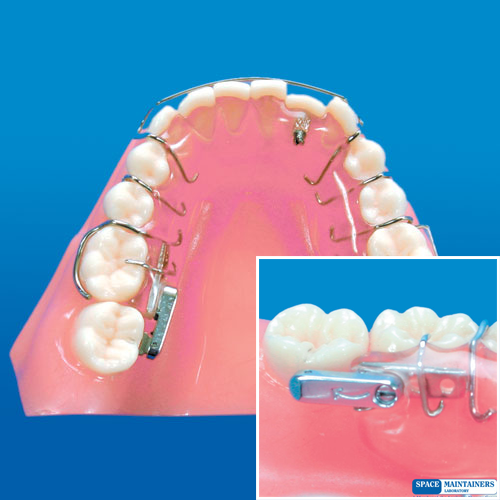 AppTheGroup's tweet photo. When the distal-most molar erupts in lingual version, this appliance is what you need: http://t.co/Jbgg1aTbCg http://t.co/MAR5qVkhVM
