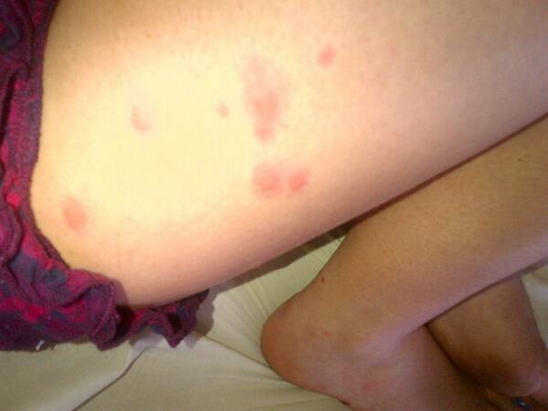 Amycharllotte's tweet photo. 49 mosquito bites! Damn things! http://t.co/mK10urqYDT
