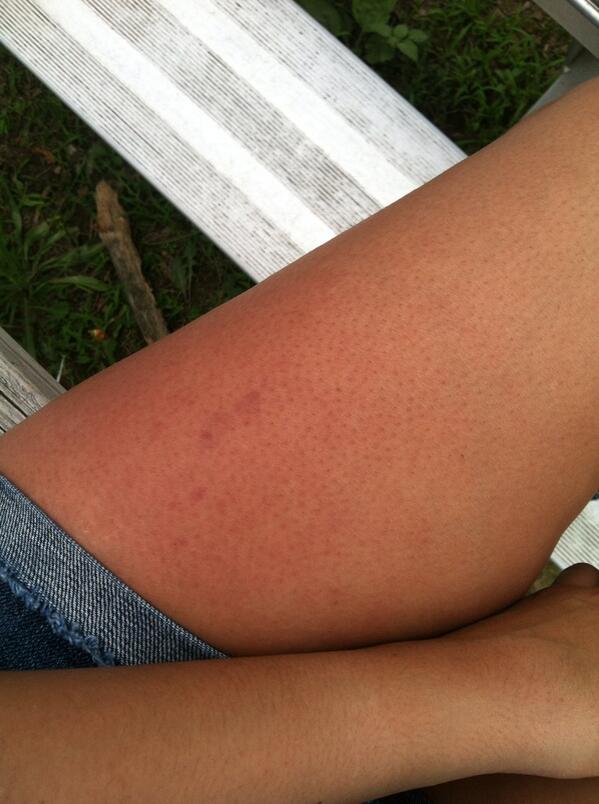 feistyasscheek_'s tweet image. threw a few pitches ... #pitcherproblems #thighslapping #softball