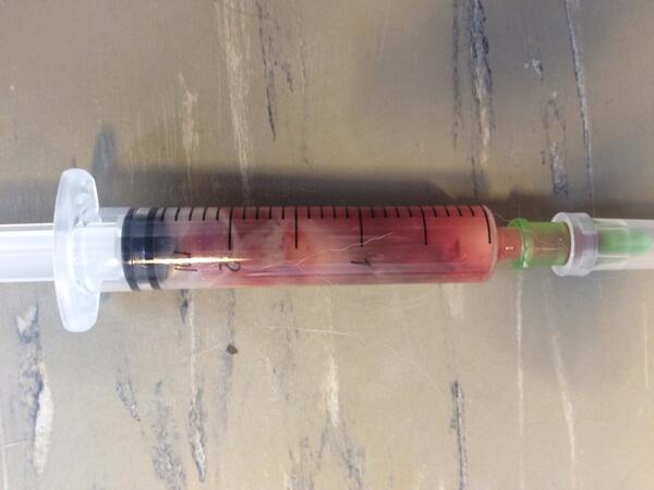 dierenartsmark's tweet image. Benauwde kat, weinig longgeluiden te horen. Tussen ribben aangeprikt, komt pure pus uit #pyothorax #vleuterweide