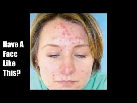 How To Make A Quick Acne Treatment - howtomakeaquick.com/how-to-make-a-…