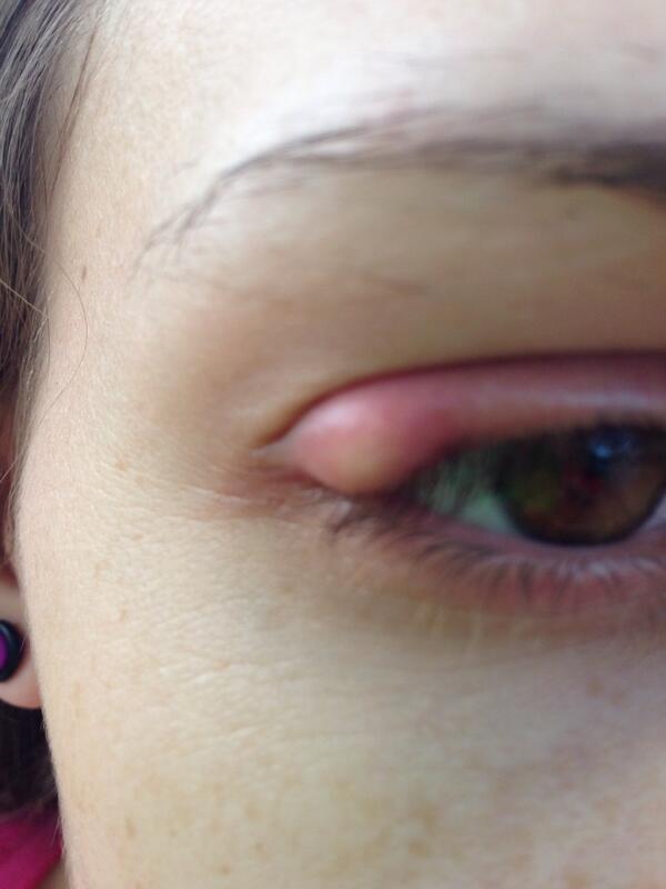 luvoverdistance's tweet photo. Soooo guys, my eye is kinda being taken over! 😷👀👎 http://t.co/e94cmLt8Ve