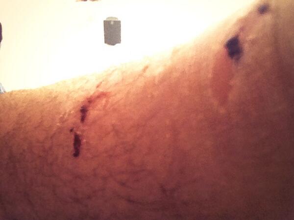 bobjames's tweet image. Try to be healthy and use bike. Park &amp;amp; return to chain set buckled. Try to ride, now need new ankle. #exercisefail