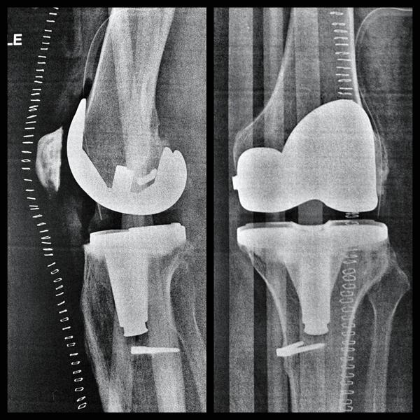 photo444's tweet photo. 1 month follow up. 1.5 weeks no cane hit 102 degrees @ PT today Released to part time work. X-ray (staples long gone) http://t.co/HGtWHM5RJJ