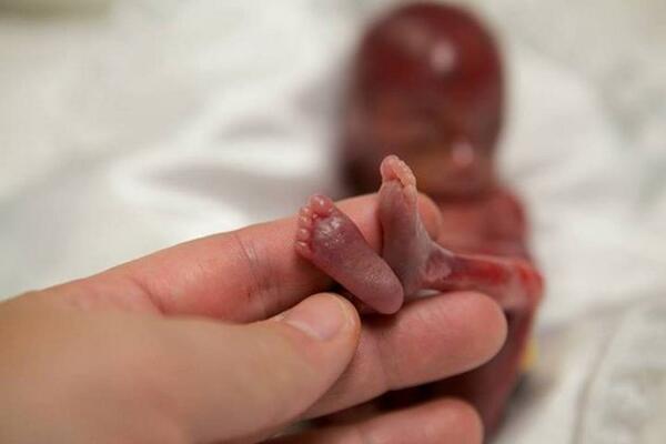 Uzivatel Elperiodico Na Twitteru El Bebe Que Conmovio Al Mundo Al Nacer A Las 19 Semanas De Gestacion Galeria Http T Co 5m56ajdwt6 Http T Co Kwywbyptdd