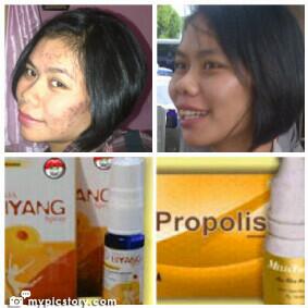 Testimoni mnghilangkan jerawat batu dg melia biyang..minat PM 288252ED