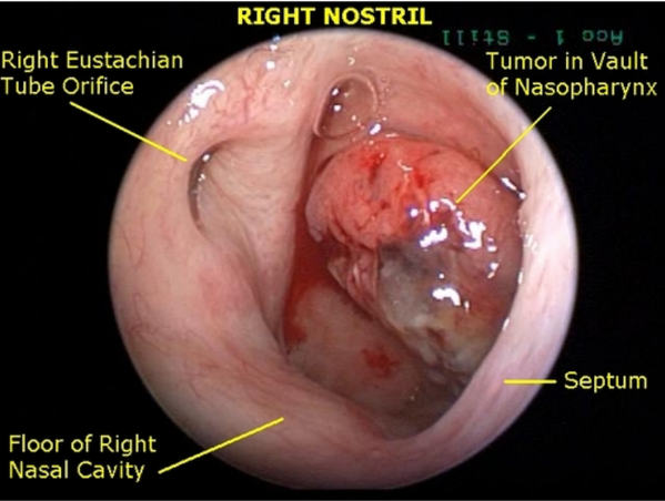 Dr Ilin Gilberto De La Torre Md Carcinoma Nasofaringeo Asintomatico Hasta Q Obstruye Tubo D Eustaquio C Obstruccion Nasal Epistaxis Usmlepathslides Http T Co Tk5xd7p77p
