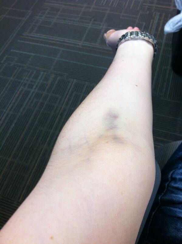 lorenraye's tweet image. I would be the WORST heroin addict ever. #bruisedveins #routinebloodwork #palegirlproblems