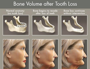 MIS_Implants's tweet photo. Explaining To Patients How Dental Implants Prevent Bone Loss
https://t.co/iltjmSKMa9 http://t.co/nPVKJcFA4C