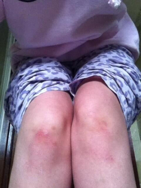 NicholaMarren93's tweet image. You know it was a good night when ya have knees like these the next day! #MightyCraic #SameAgainNextWeek