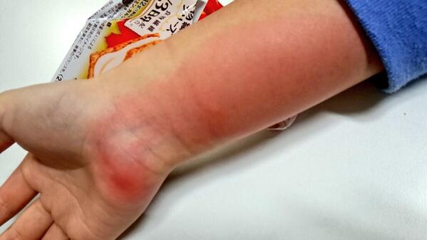 Y Montakeshinya 体質なんかな D 蚊まじで滅びてくんないかな 笑