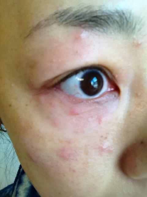 かおなし Itabasiiko Lllpuplll Makeanovel Sechuko33 私はこの夏 コパトーンの 日焼け止めで白斑ができました 沖縄移住してるし 3 15も西に避難してたので 放射能の影響はあまり受けてない筈なのですが