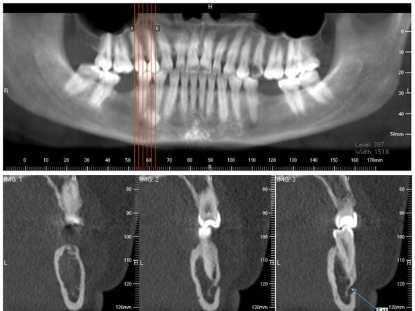 RDMAXCA's tweet photo. Imagen hiperdensa  circular lado Der zona premolar,axiales muestran canal mandíbular y foramen mentoniano íntegro http://t.co/HJlSqNukKv