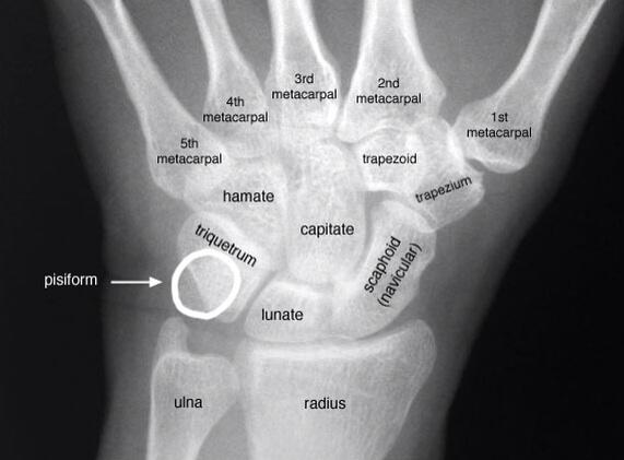 OrthoHub's tweet photo. Carpal bones http://t.co/lWOPCcd9mw