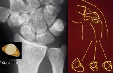 OrthoHub's tweet photo. Another sign of scapholunate dissociation is the signet ring sign due to rotation of scaphoid bone. http://t.co/qaegSSrrn2