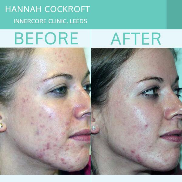 Since it's her birthday today, here's @HCDream2012's before and after pictures. Doesn't she look great?