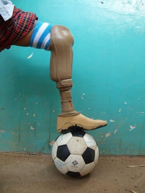 A photo guaranteed to put a smile on your face! A prosthetic leg means a lot when you're a young aspiring footballer.