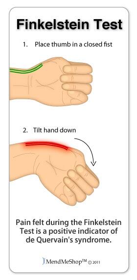 OrthoHub's tweet photo. De Quervain disease: tenosynovitis of the extensor pollicis brevis and abductor pollicis longus tendons. http://t.co/pXKah0HEet