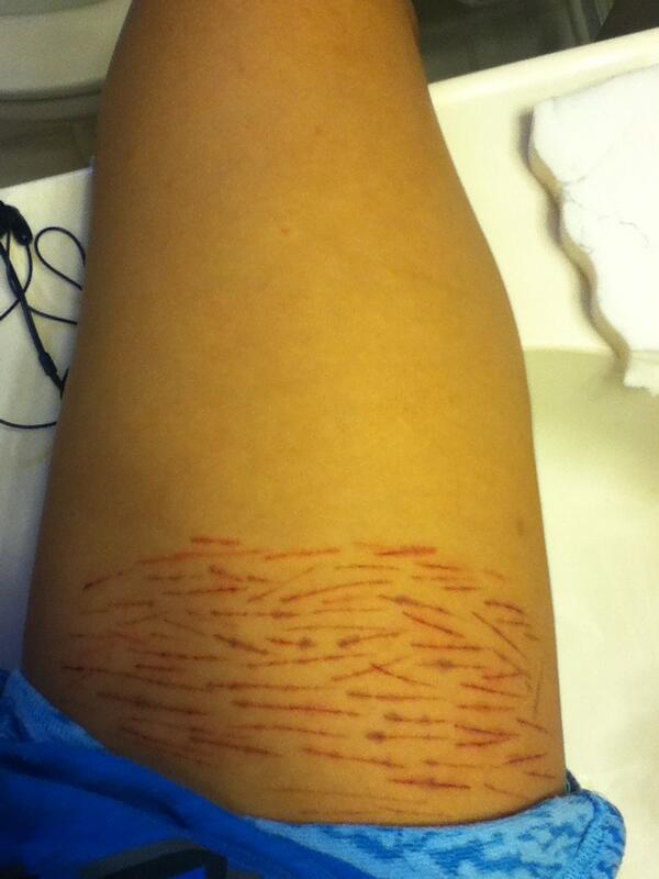 Call_Me_Fat's tweet image. PLEASE HELP! Is it supposed to look purple around some cuts?