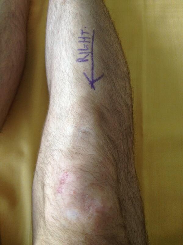 kcub05's tweet photo. At least they won't pick the wrong knee!!! http://t.co/cgcHfiUKGm
