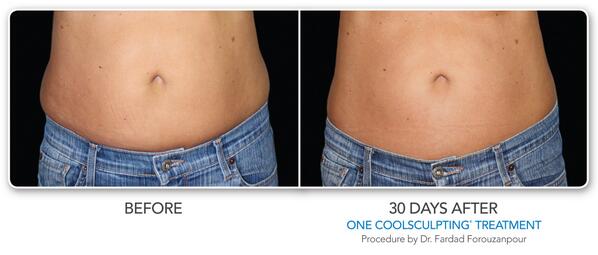 Take a look at these incredible CoolSculpting before and after shots -