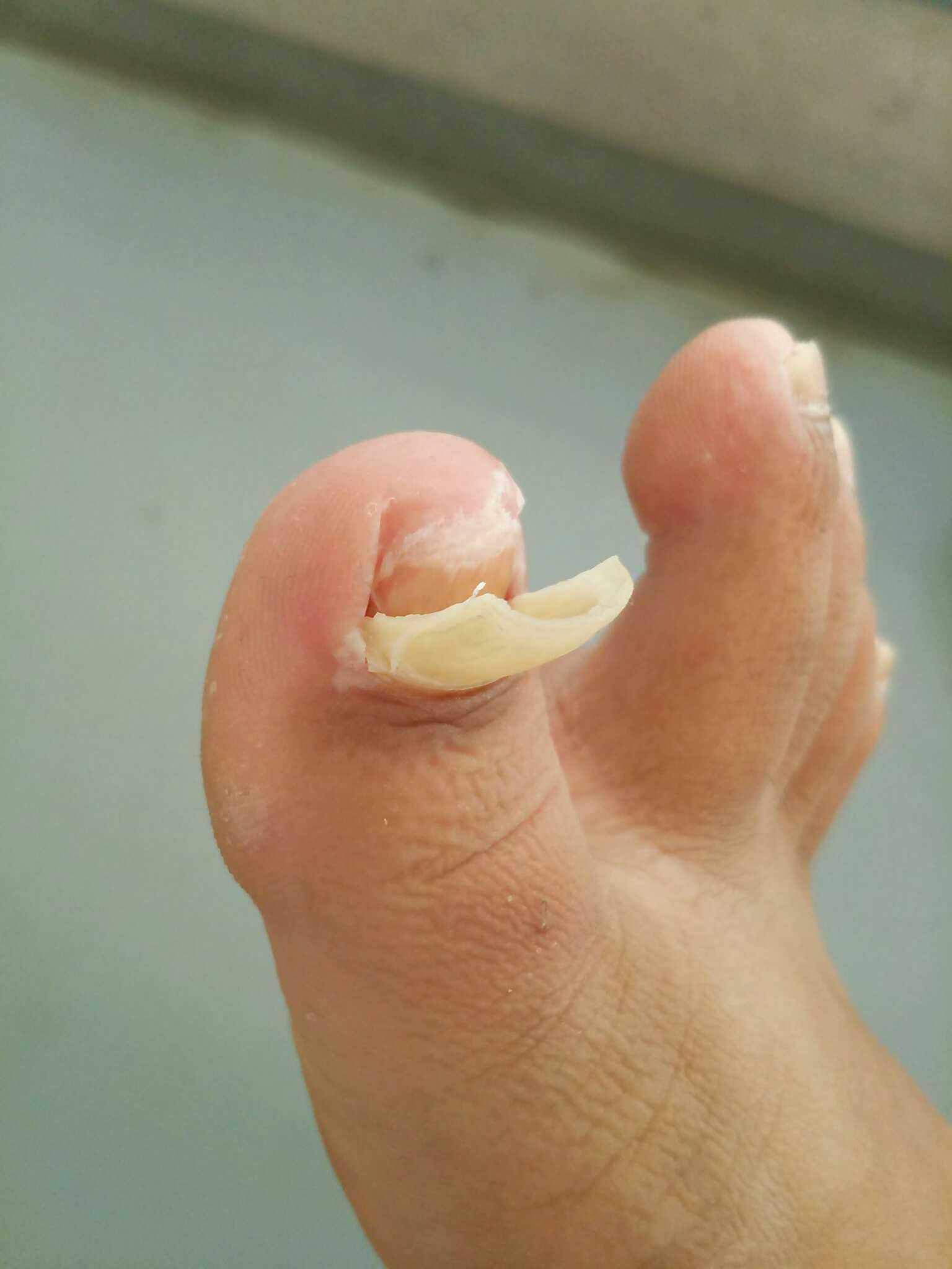 Tark 3週間前に道場で組手中に剥がれかけた爪を以前専門の人に聞いた方法で治療してたが 3時間ほどプールで脂肪燃焼してたら爪 がふやかって剥がれた Wしかし 下には再生中の新しい爪がw痛くは無いが再生中なんて初めて見たぜぃw Http T Co C39v4l7vpw