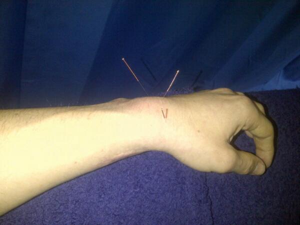Cullie44's tweet photo. Bit of physio and acupuncture #hateneedles #betterwork http://t.co/vzfuRoWT8u