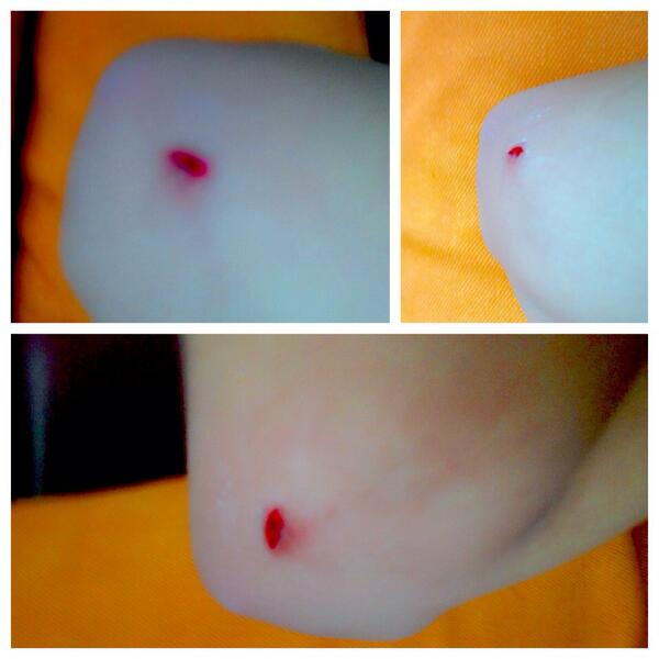 Getwellsoon♥"@ghea_ghalia: Ontheway bdg. Pake acara jatuh dulu. Soyeay!( '-')9 "