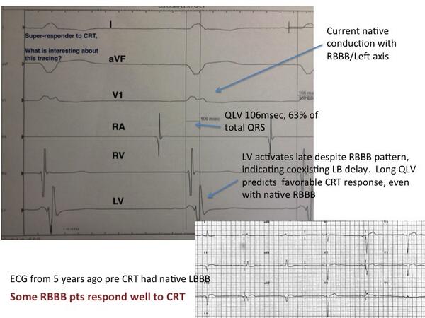 Edward J Schloss Md Auf Twitter F U To Crt Case Here S A Rbbb Chf Pt With Normalized Ef After Crt Note Evidence Of Lb Delay By Qlv Old Ecg Http T Co 2zrjcy8all Edward J Schloss Md Auf Twitter F U To Crt Case Here S A Rbbb Chf Pt With Normalized Ef After Crt Note Evidence Of Lb Delay By Qlv Old Ecg Http T Co 2zrjcy8all